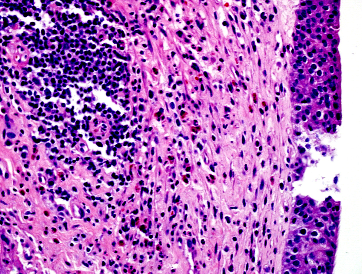 Inflammatory infiltrate with marked eosinophils