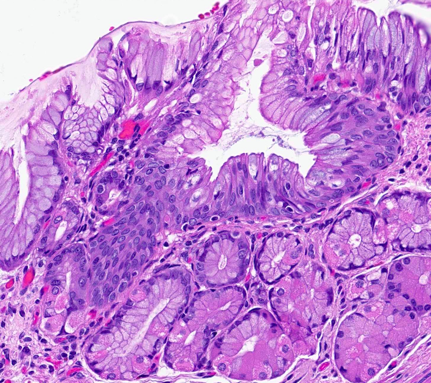Pathology Outlines Barrett Esophagus pathology-outlines-barrett-esophagus