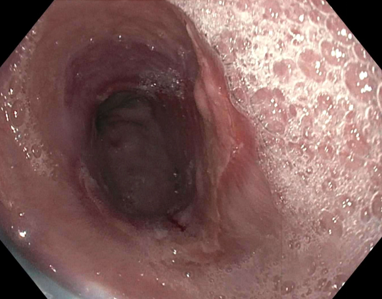 Ulcerated esophageal mucosa