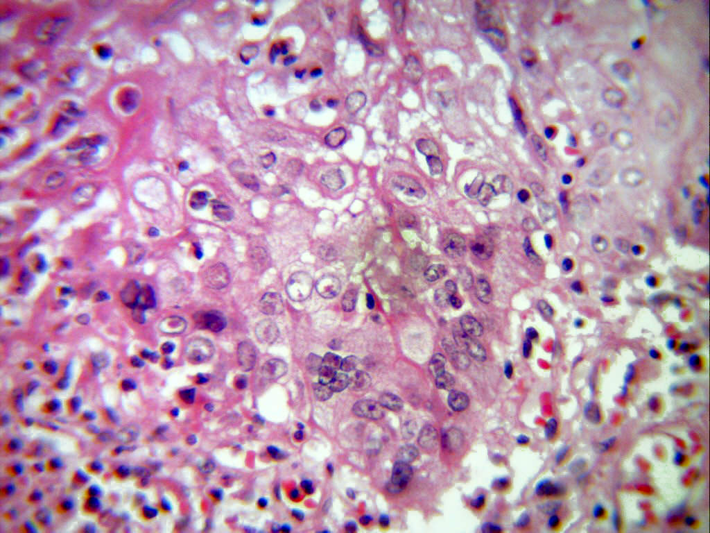 Pathology Outlines Herpes Simplex Esophagitis