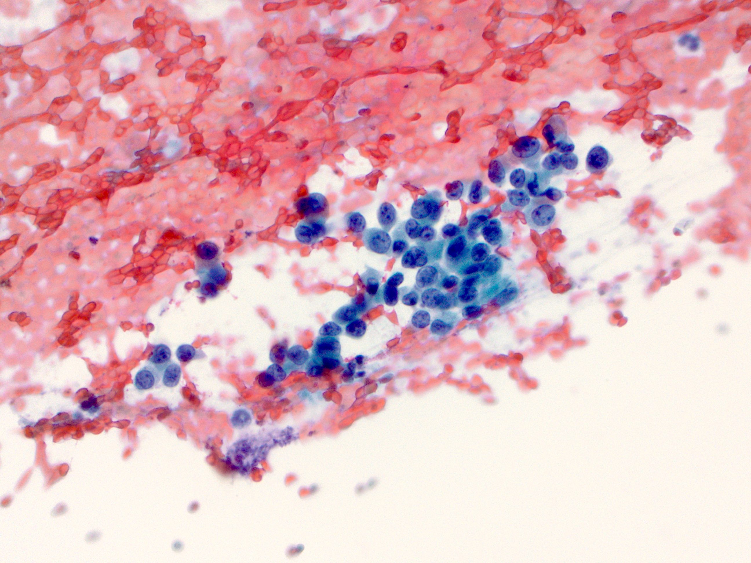 Malignant cells on Pap