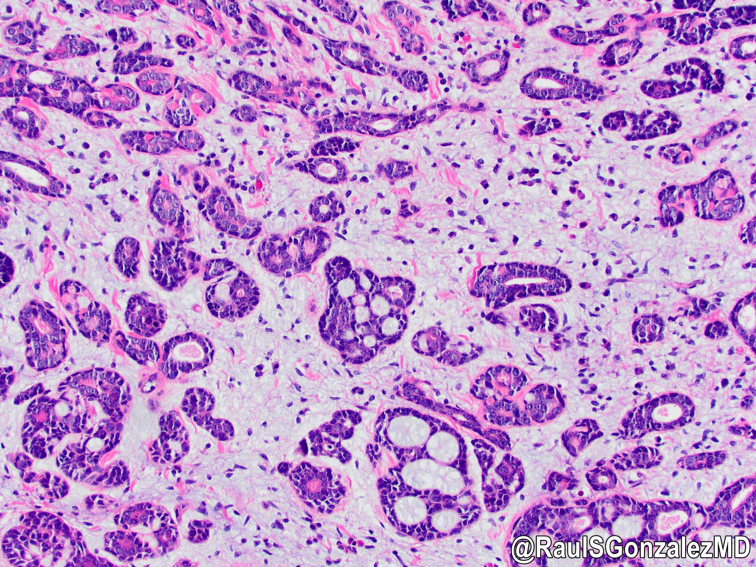 Adenoid cystic carcinoma