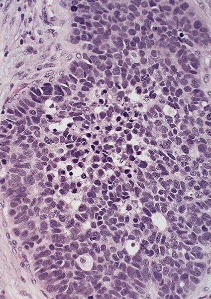 Peripheral basal type cells