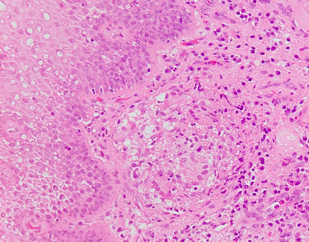 Pathology Outlines Crohn's disease