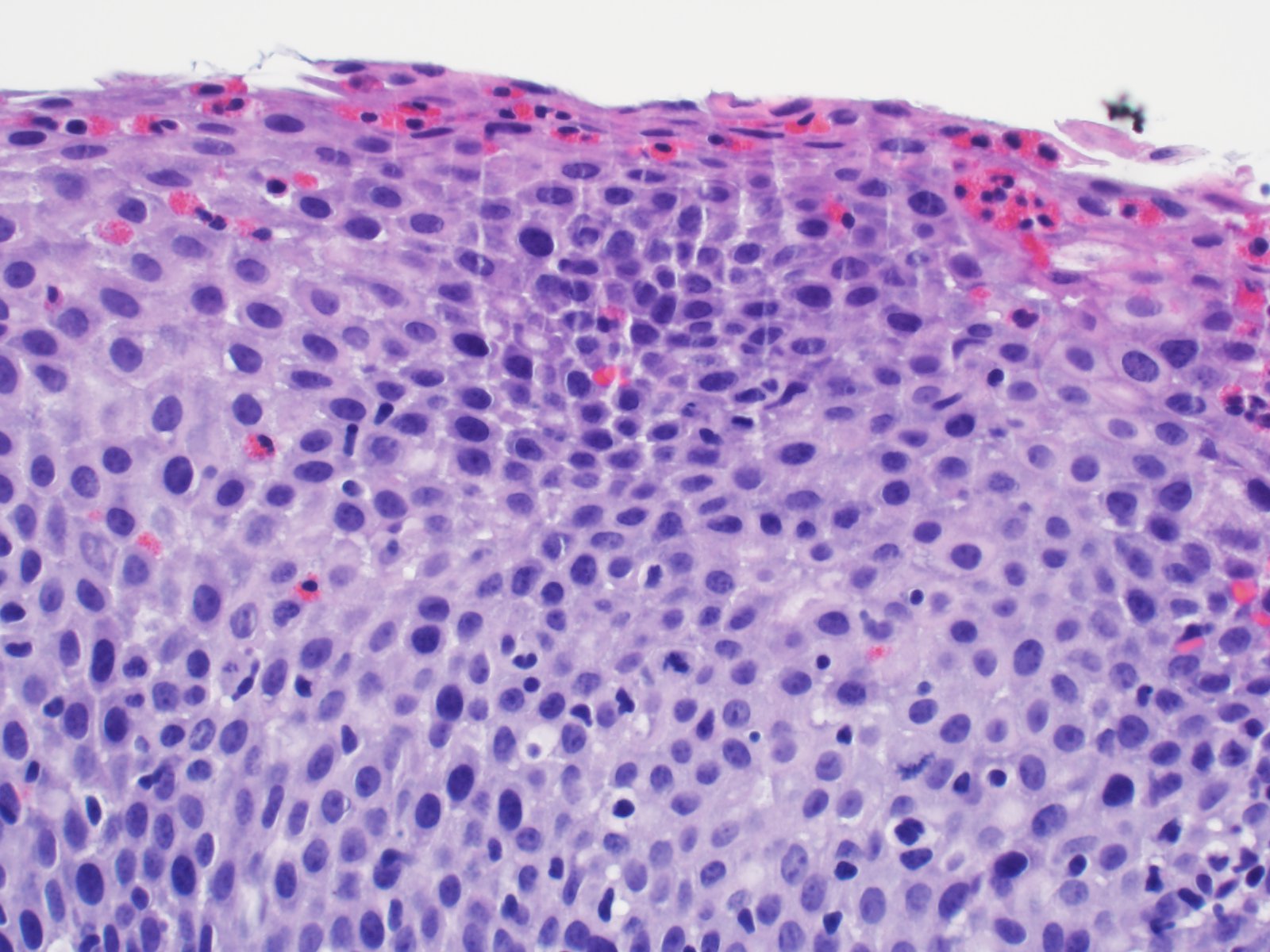 Pathology Outlines Eosinophilic Esophagitis