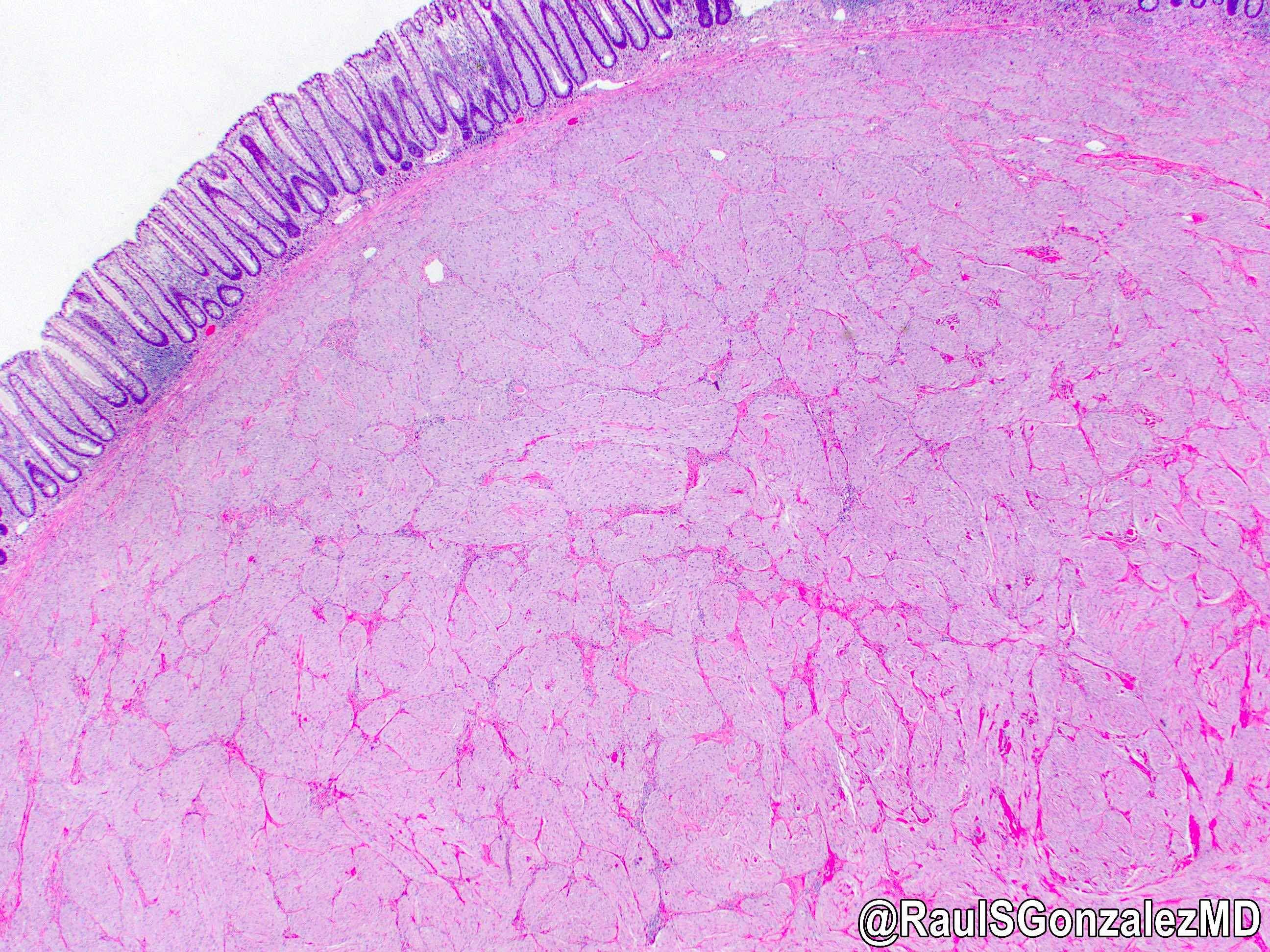 Granular cell tumor