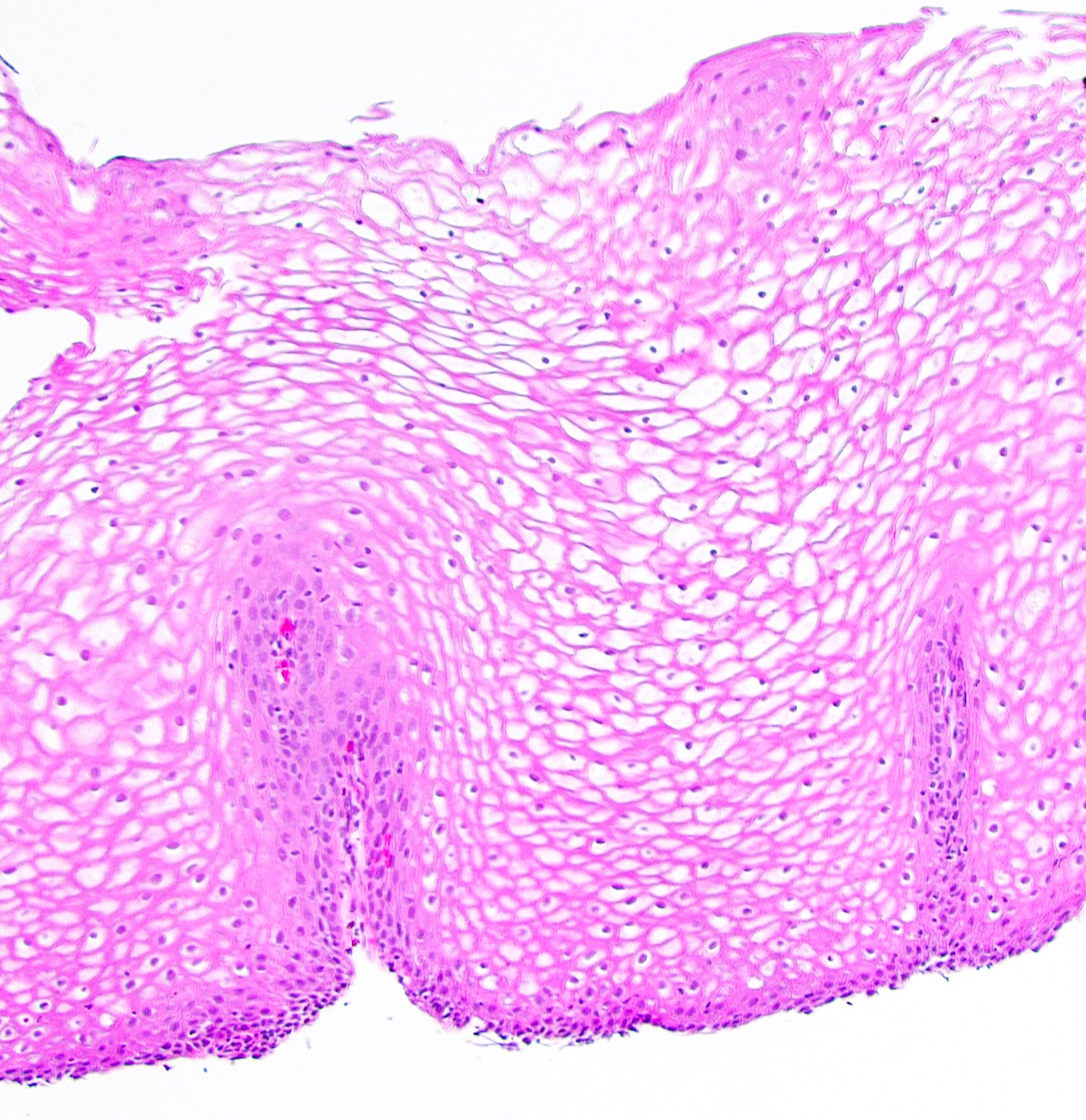 Esophageal squamous mucosa with abundant intracytoplasmic glycogen