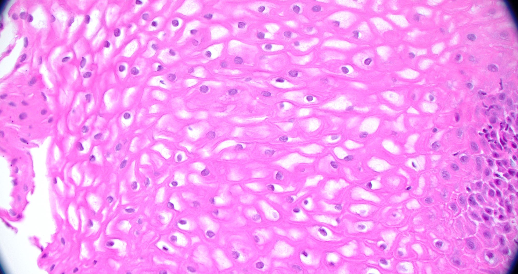 Clear cytoplasm of squamous epithelial cells
