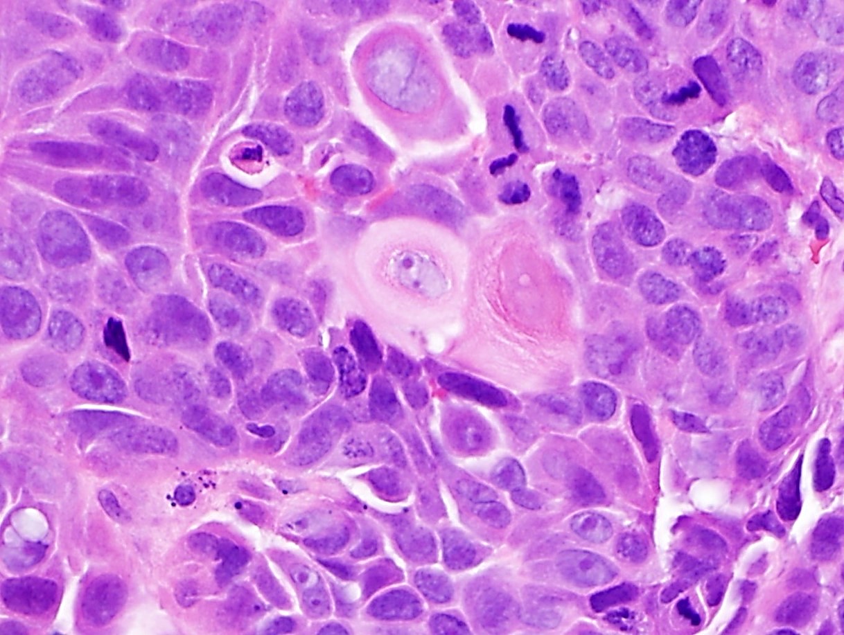Moderately differentiated carcinoma