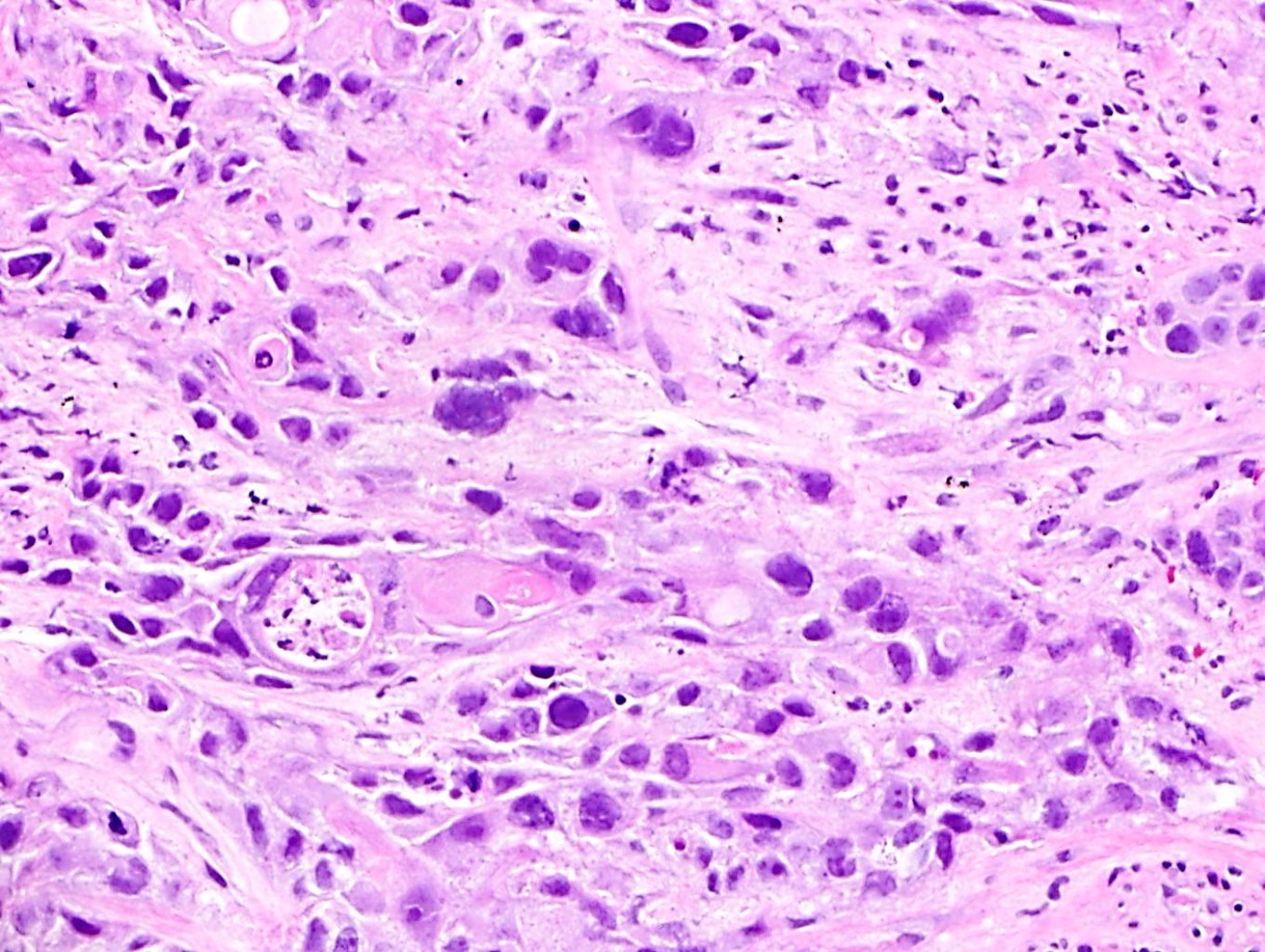Poorly differentiated carcinoma