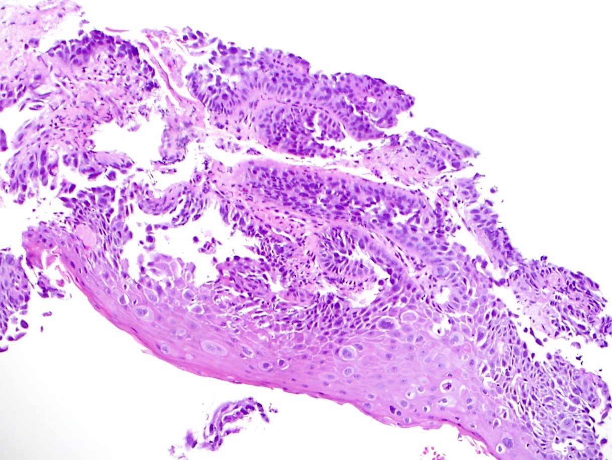 Carcinoma with pagetoid cells