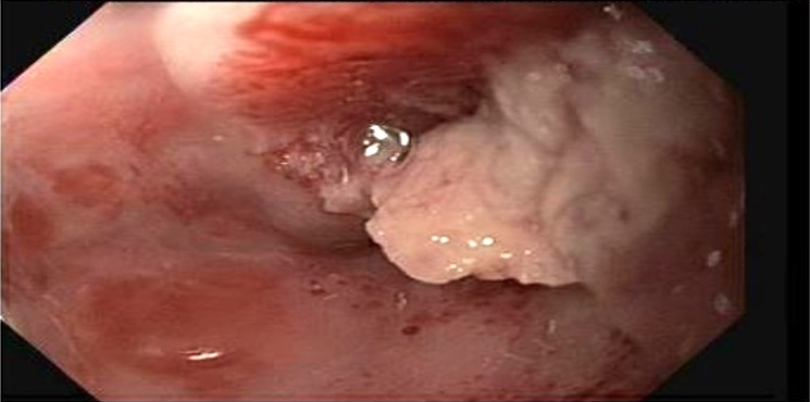 Mucosal tearing and ulceration