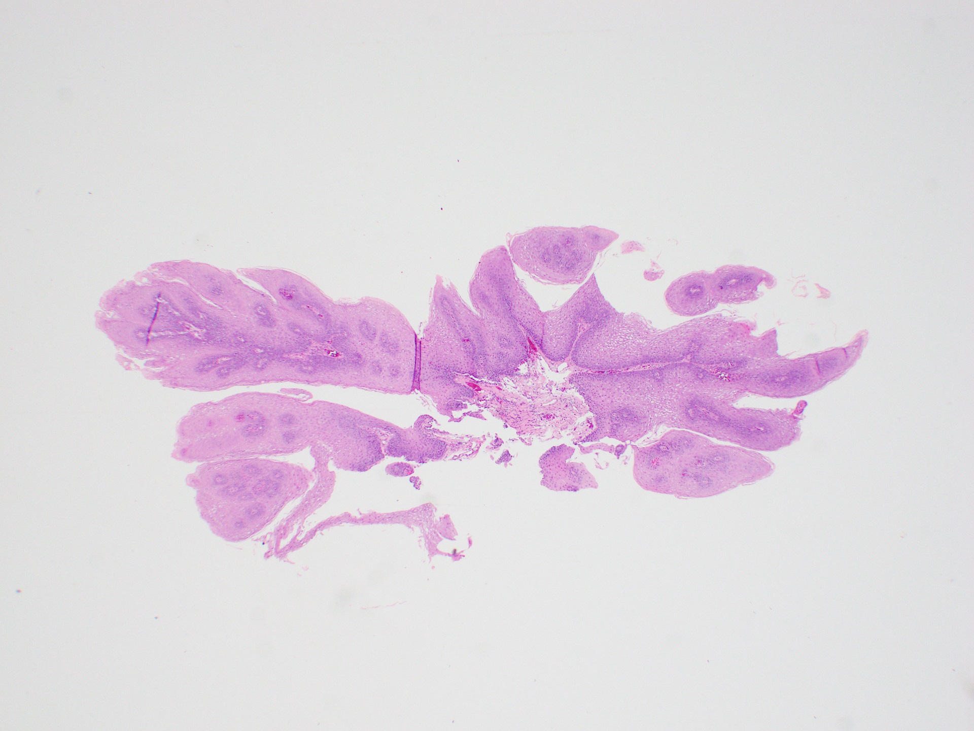 squamous papilloma of esophagus pathology outlines