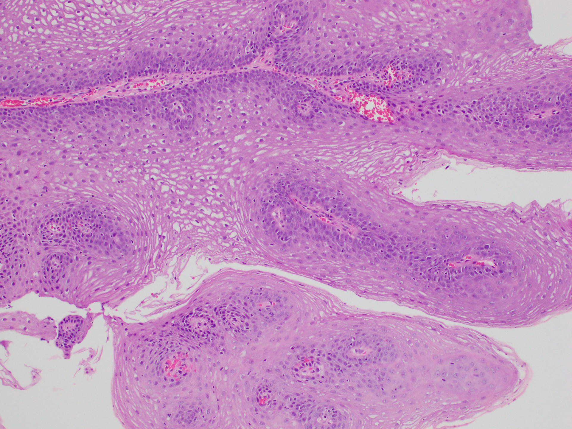 Squamous papilloma pathology outlines skin, Papilloma is squamous