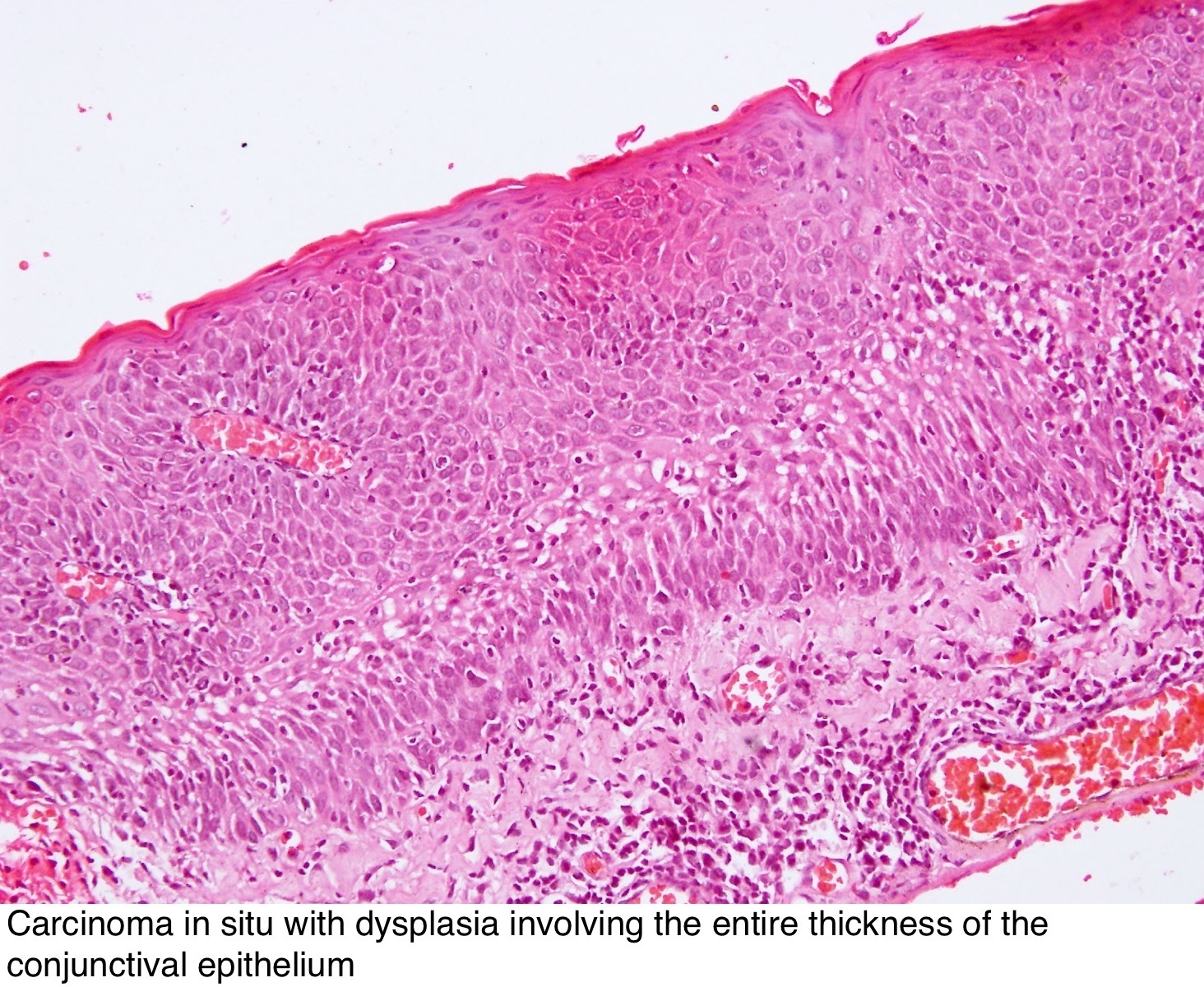 conjunctival squamous papilloma pathology