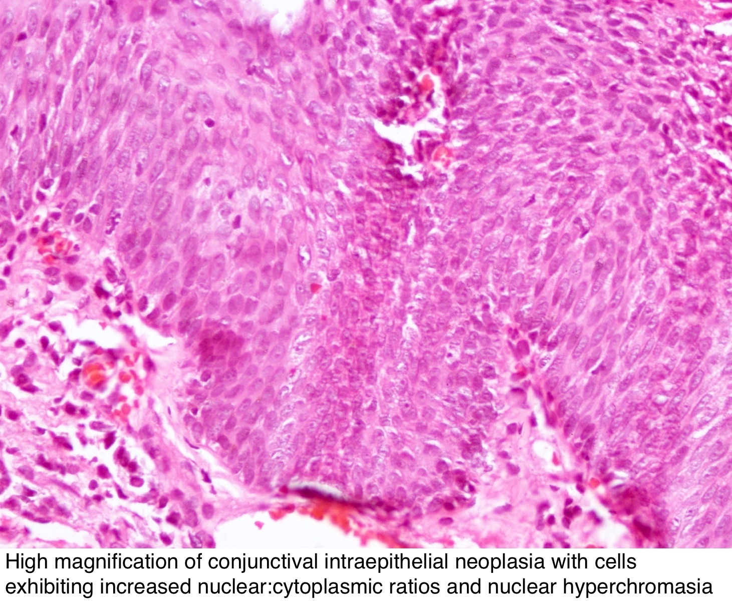 conjunctival papilloma pathology outlines mesaj condilom