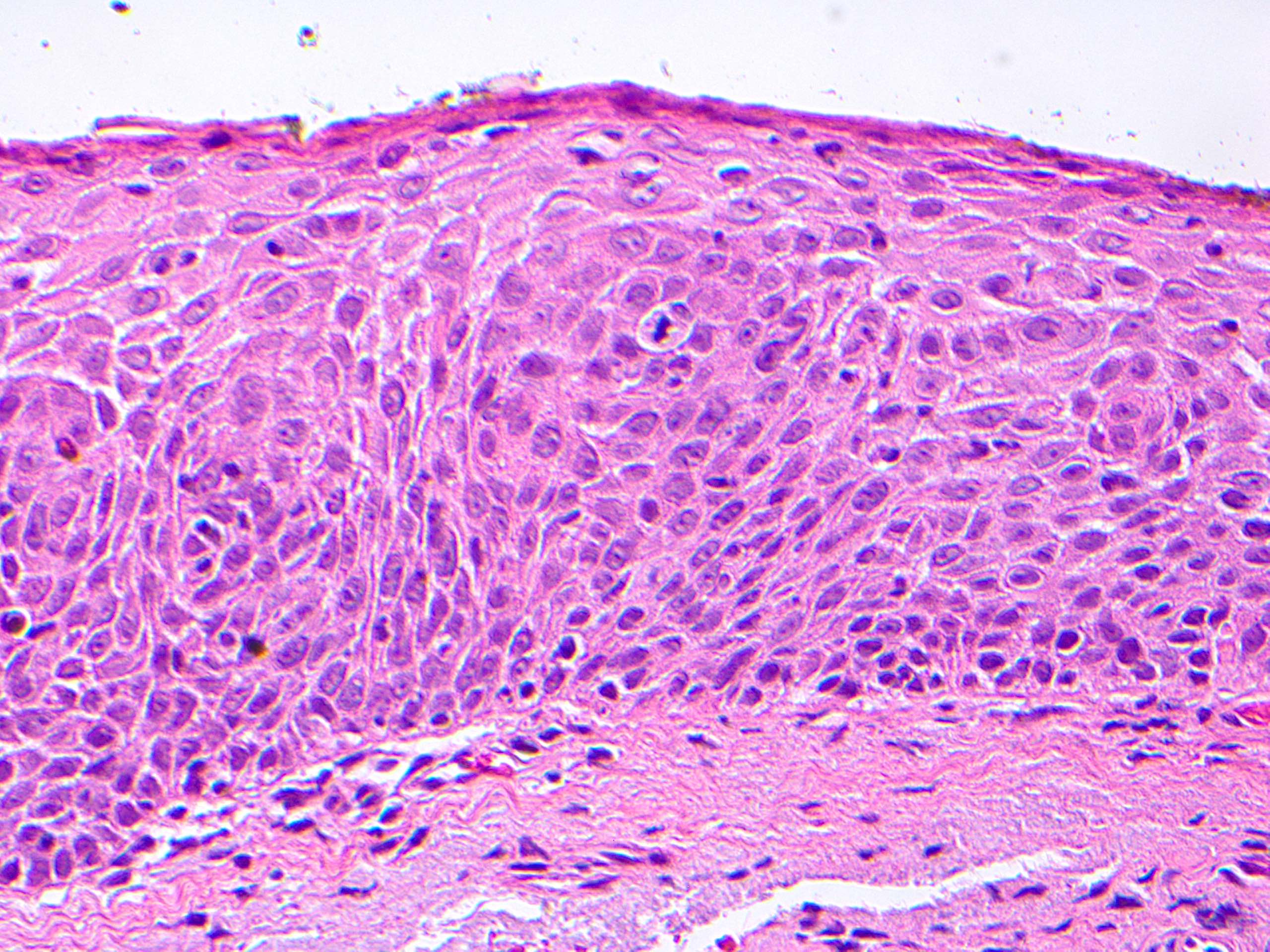conjunctival squamous papilloma pathology