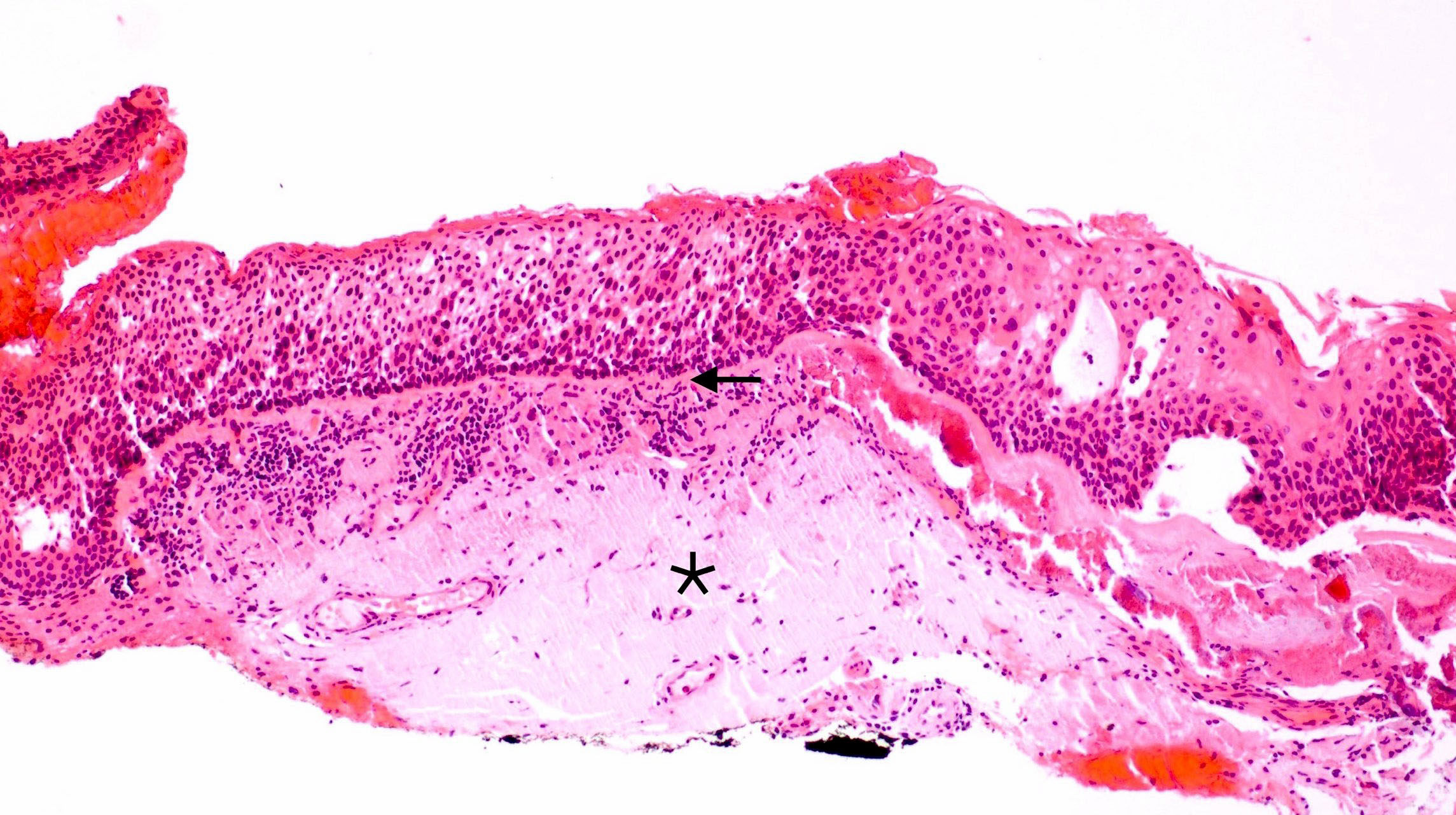 Actinic keratosis carcinoma in situ
