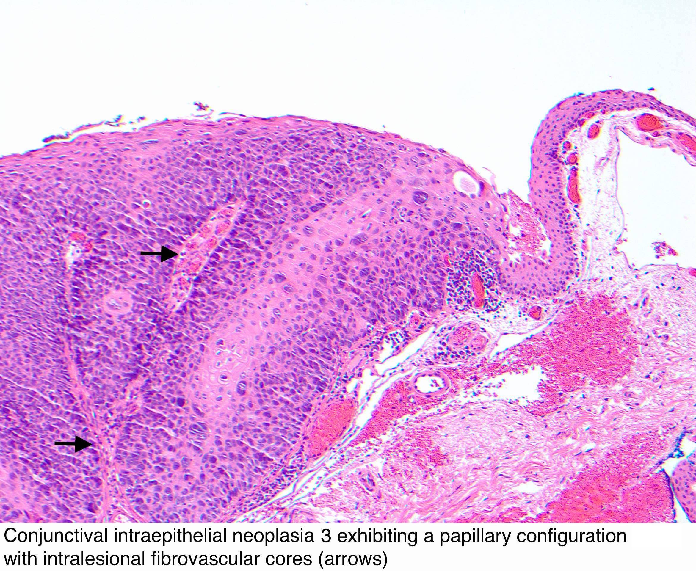 conjunctiva papilloma pathology litiera cu un vierme