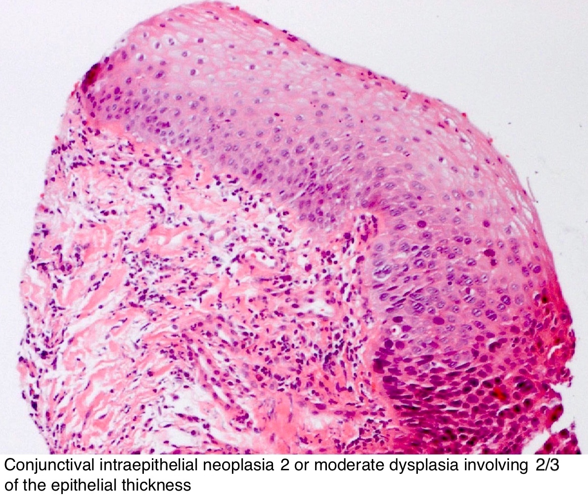 conjunctival papilloma pathology outlines cum să retrag papilomele pe față