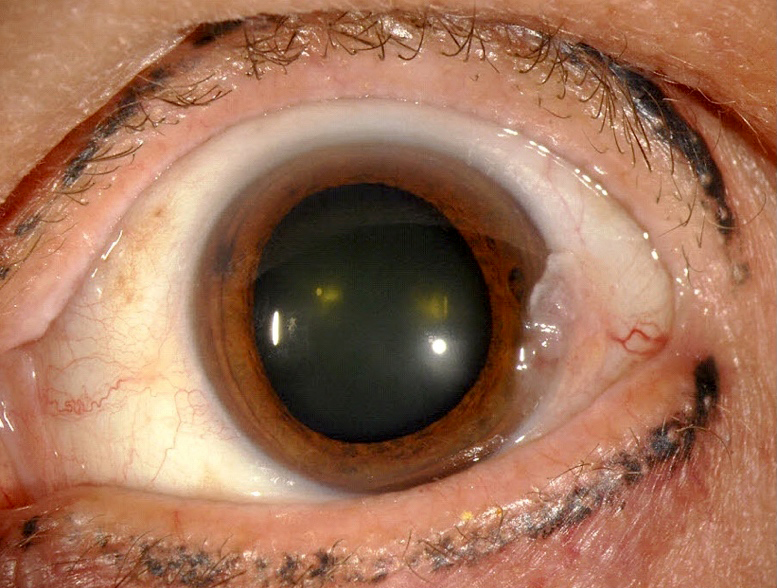 Conjunctival lesion in the limbus extending to the cornea