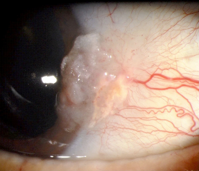 Conjunctival lesion in the limbus extending to the cornea