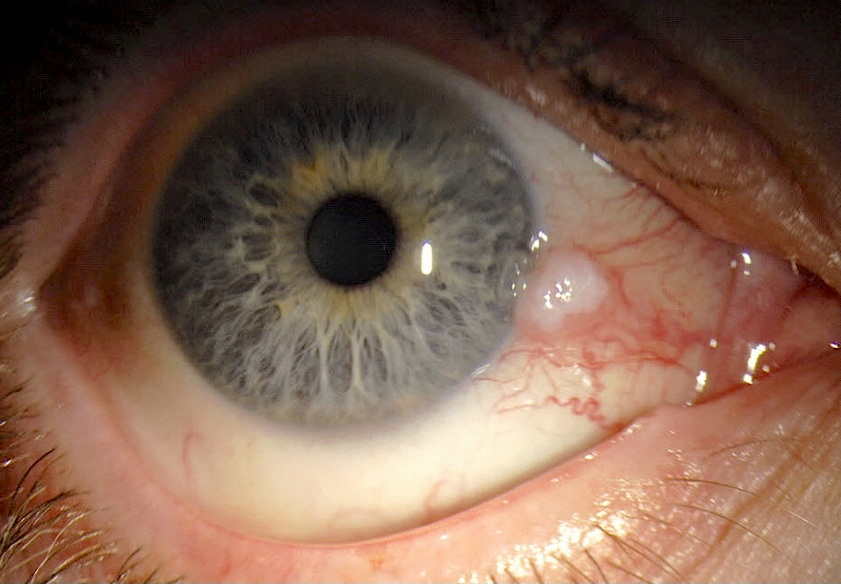 Limbal leukoplakic appearing lesion with feeder vessels