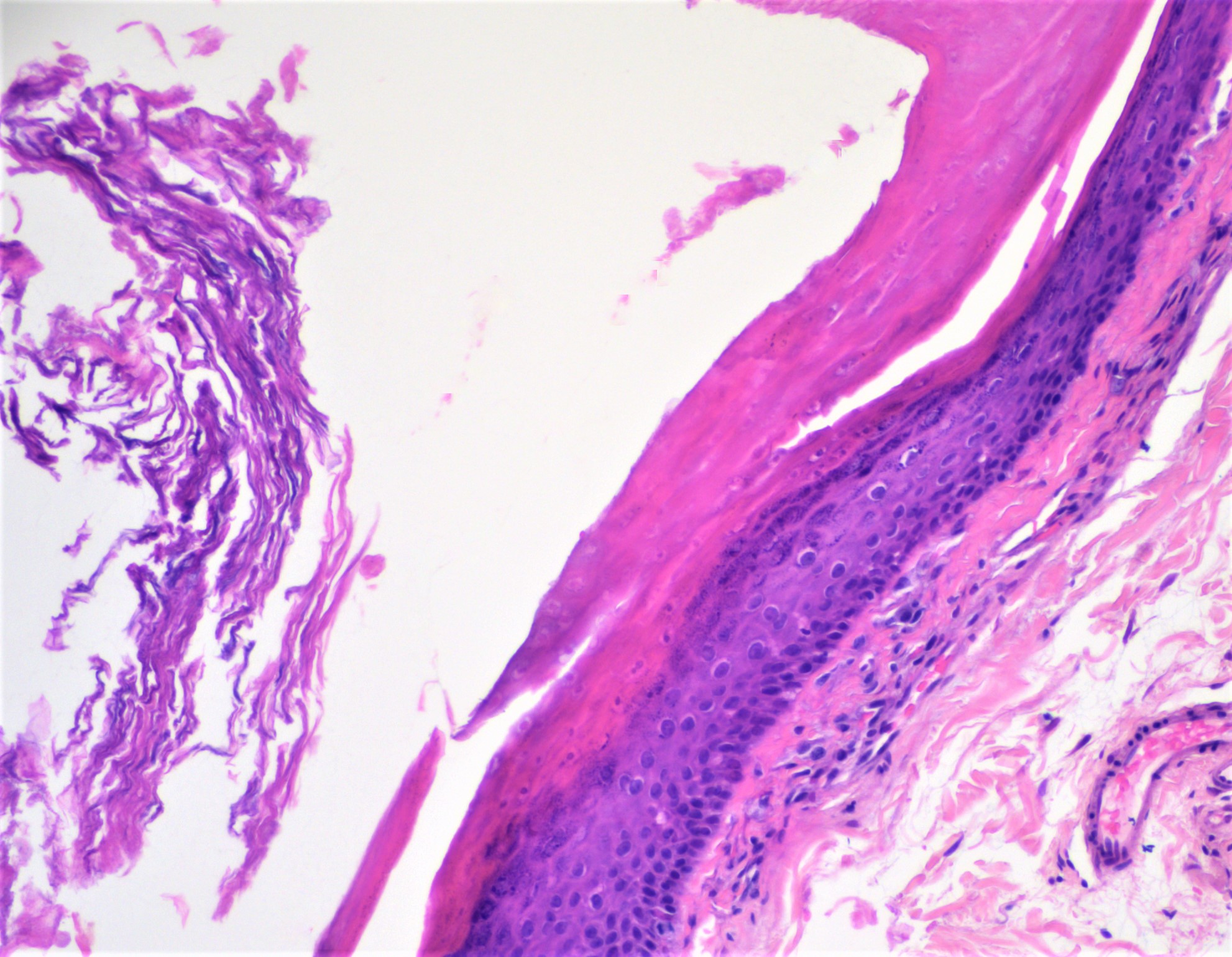 Epidermal cyst, granular layer