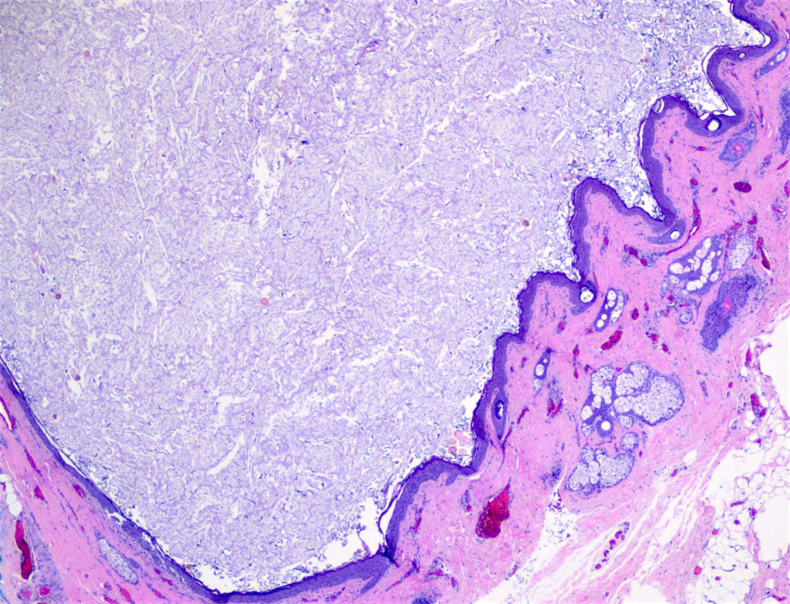 Dermoid cyst, keratinaceous contents