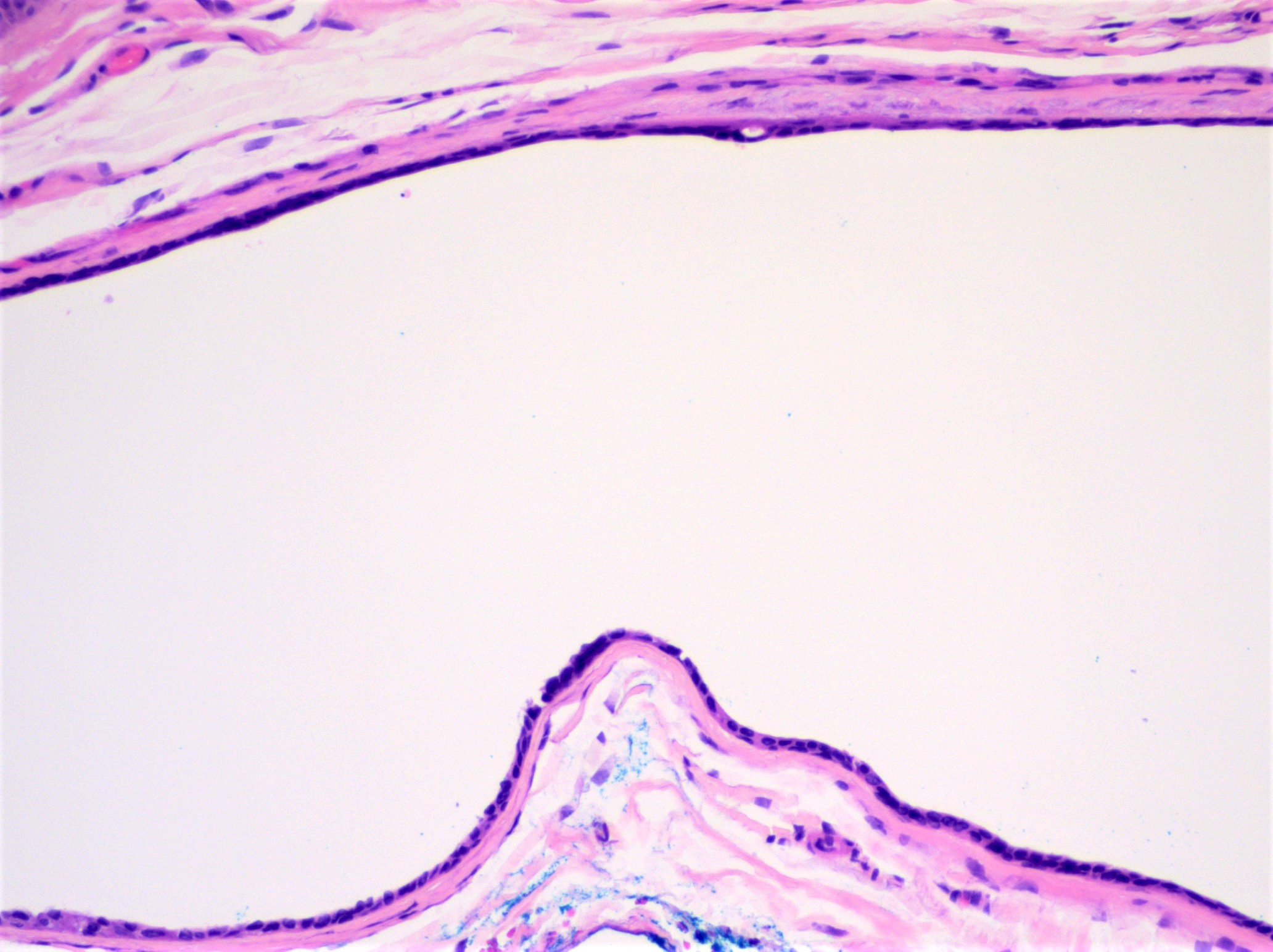 Eccrine hidrocystoma, attenuated lining