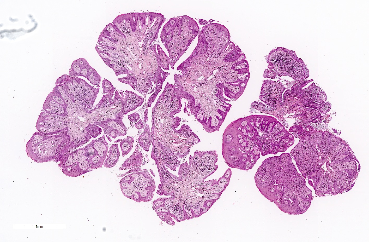 Finger-like projections of the neoplastic process