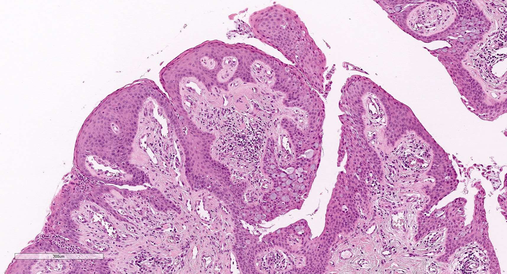 Acanthotic epithelium with fibrovascular cores