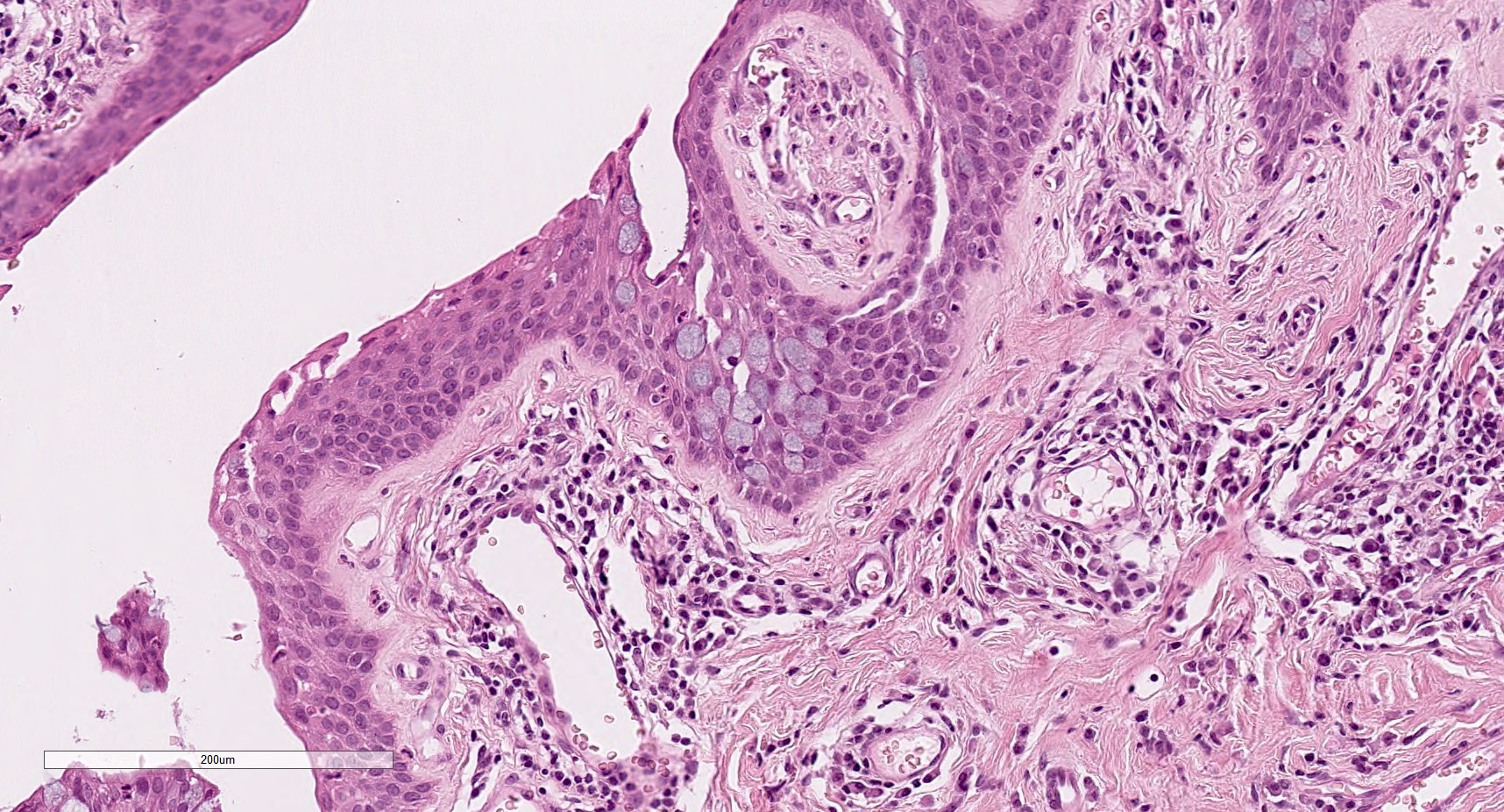 conjunctival squamous papilloma histology