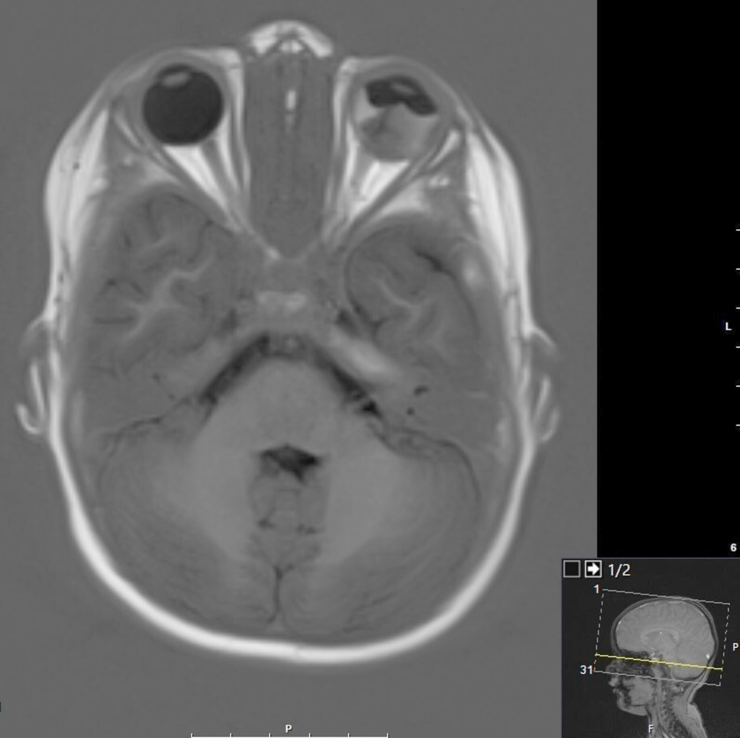MRI intraocular mass exophytic