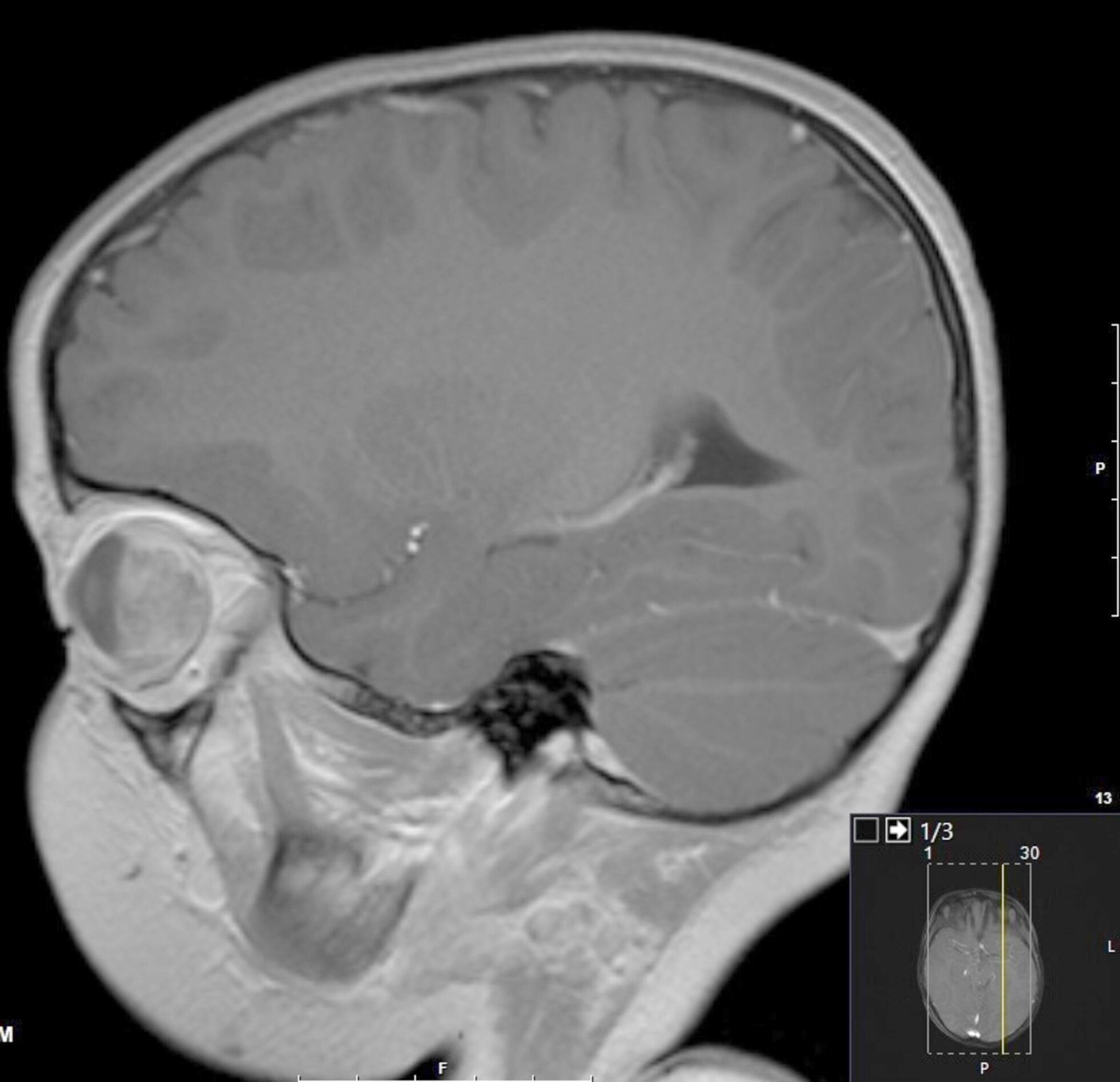 MRI sagittal heterogeneous signal