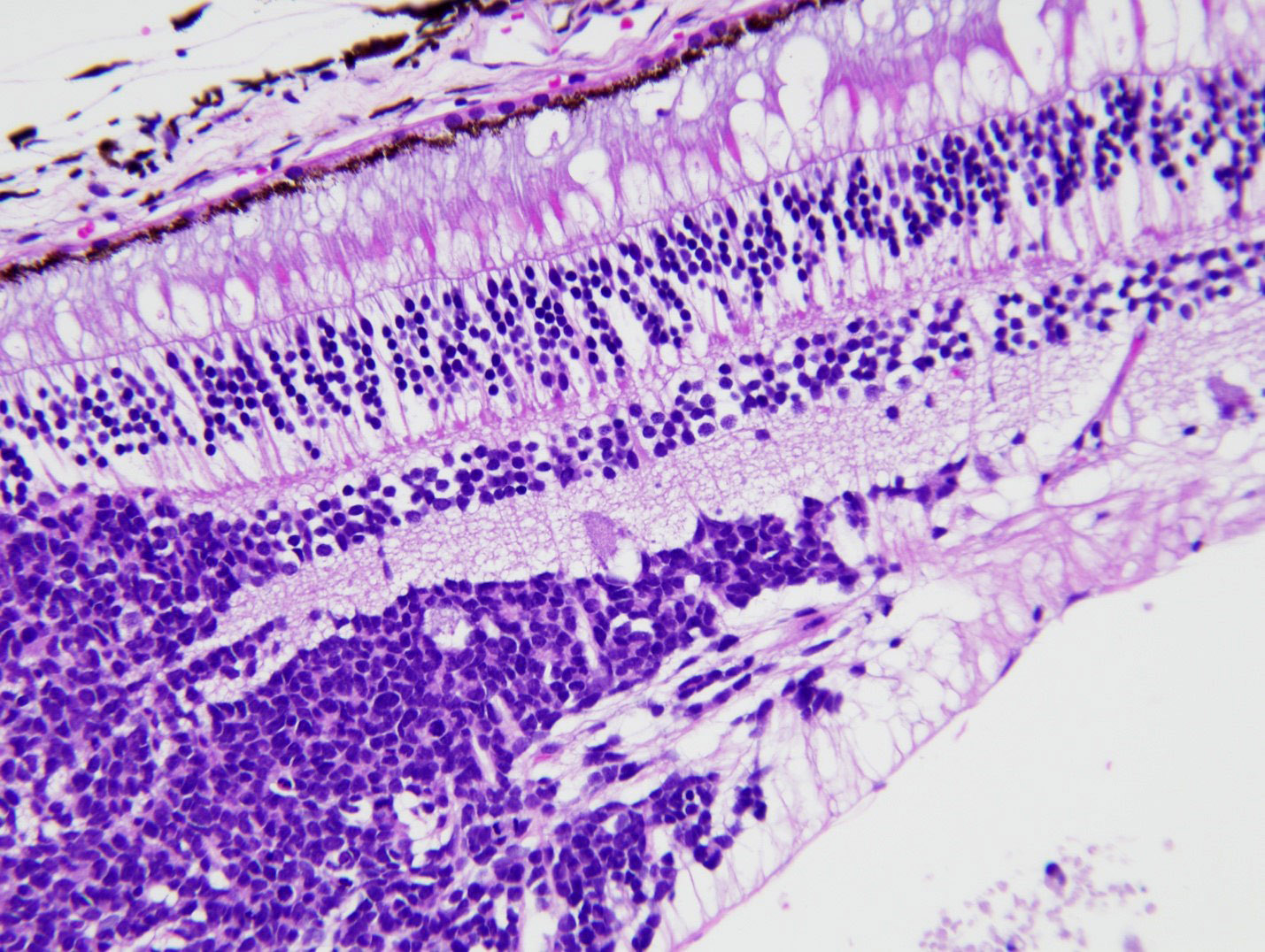 Retinoblastoma infiltrating normal retina