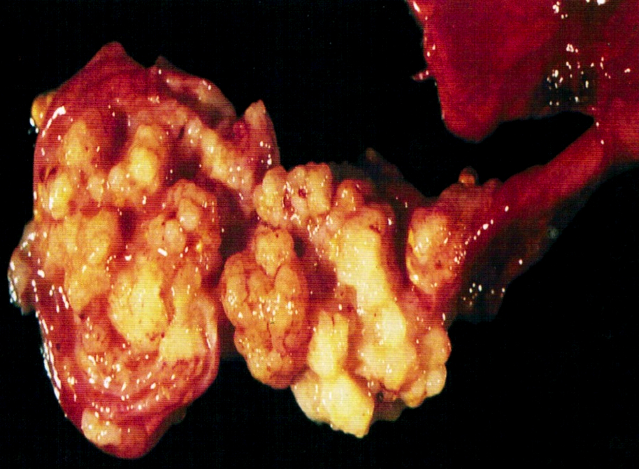 Papillary tumor attached to mucosa