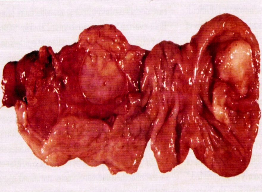 Solid nodule of tumor