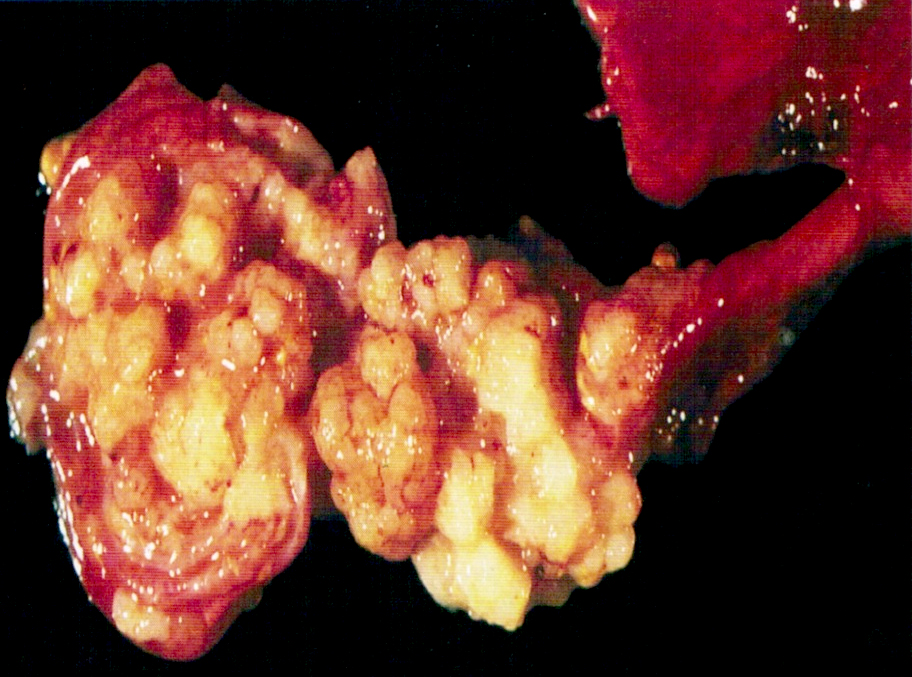 Papillary tumor attached to mucosa