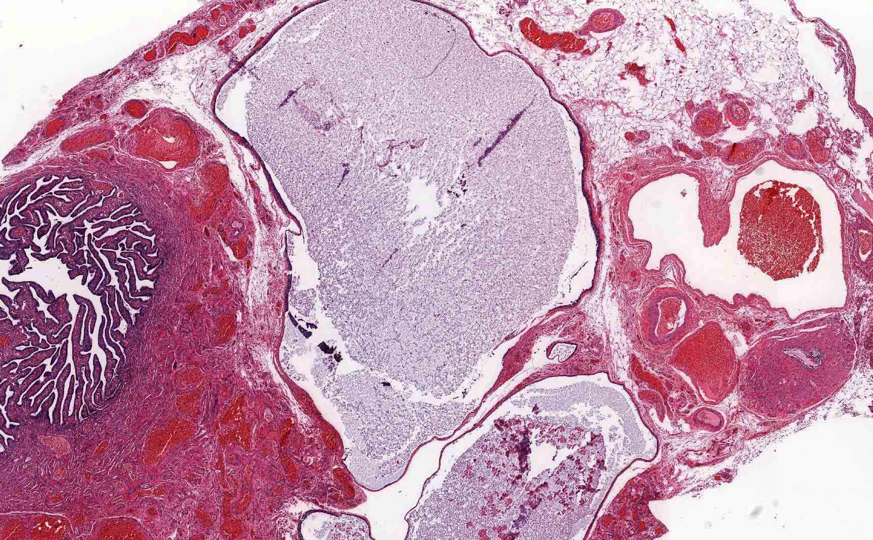 Paratubal cysts adjacent to fallopian tube