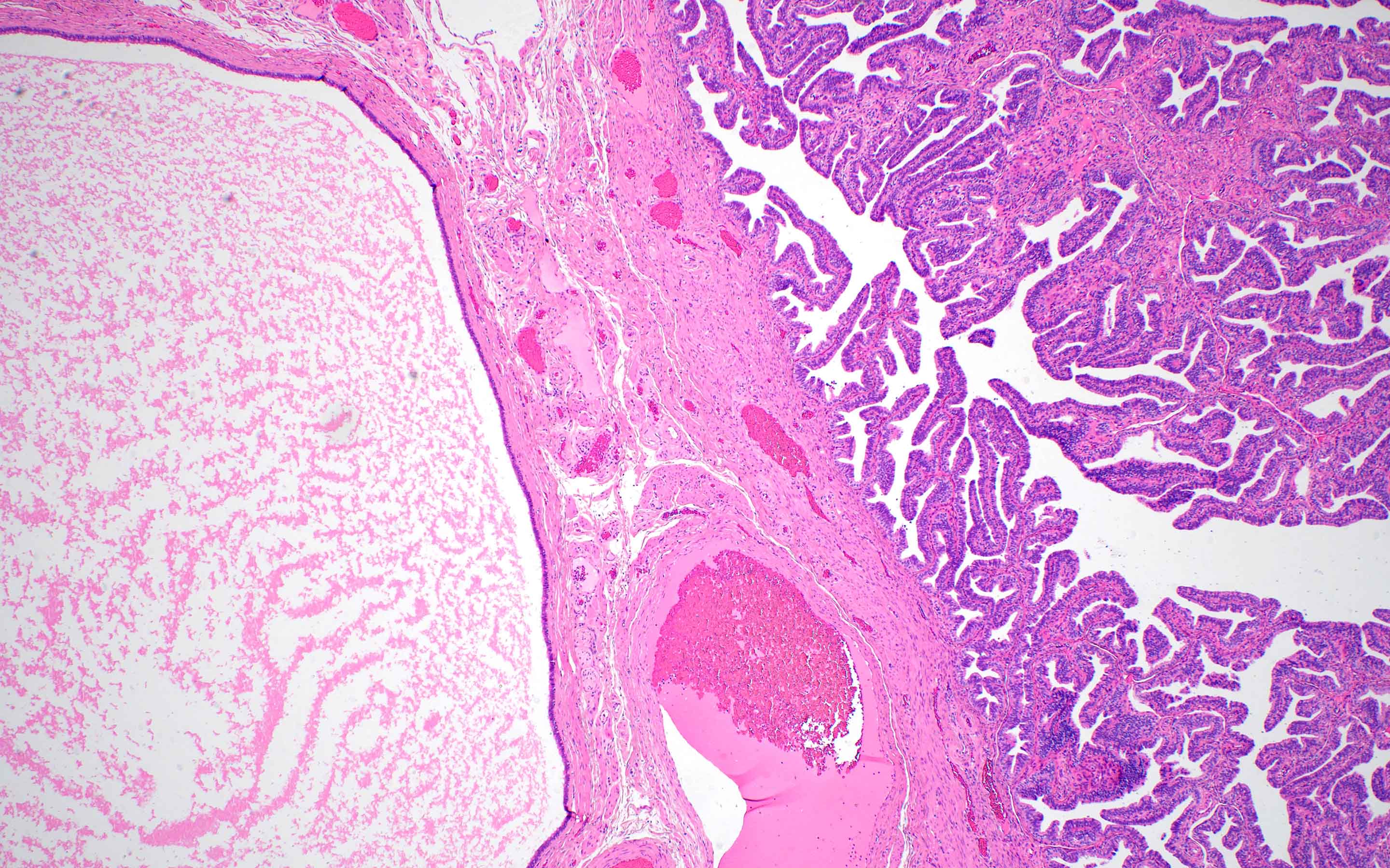 Simple cyst adjacent to fallopian tube