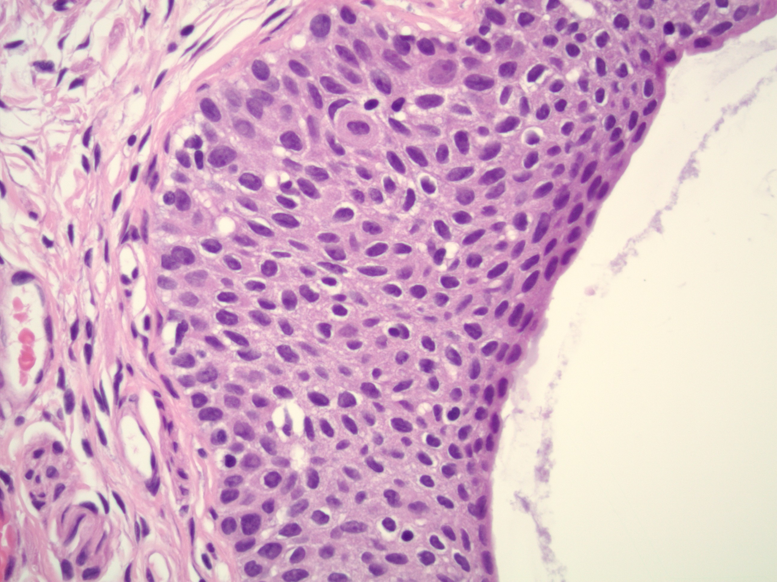 Walthard cell nests, incidental finding