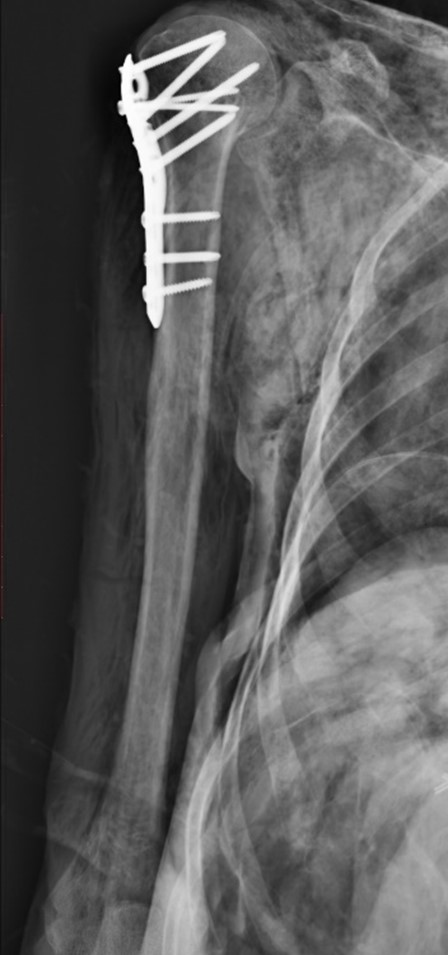 Postmortem shoulder radiograph