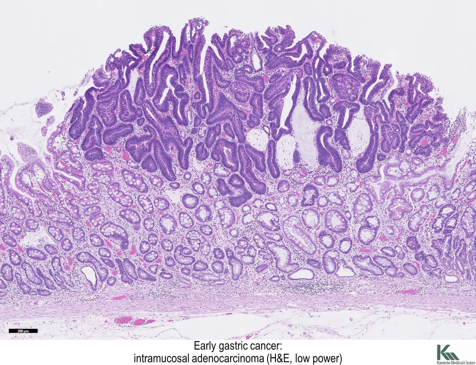 gastric cancer pathology)