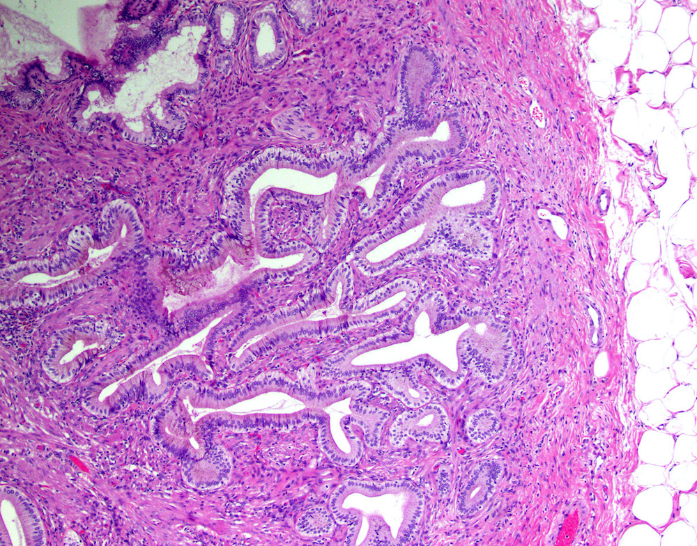 Gallbladder Polyp Histology