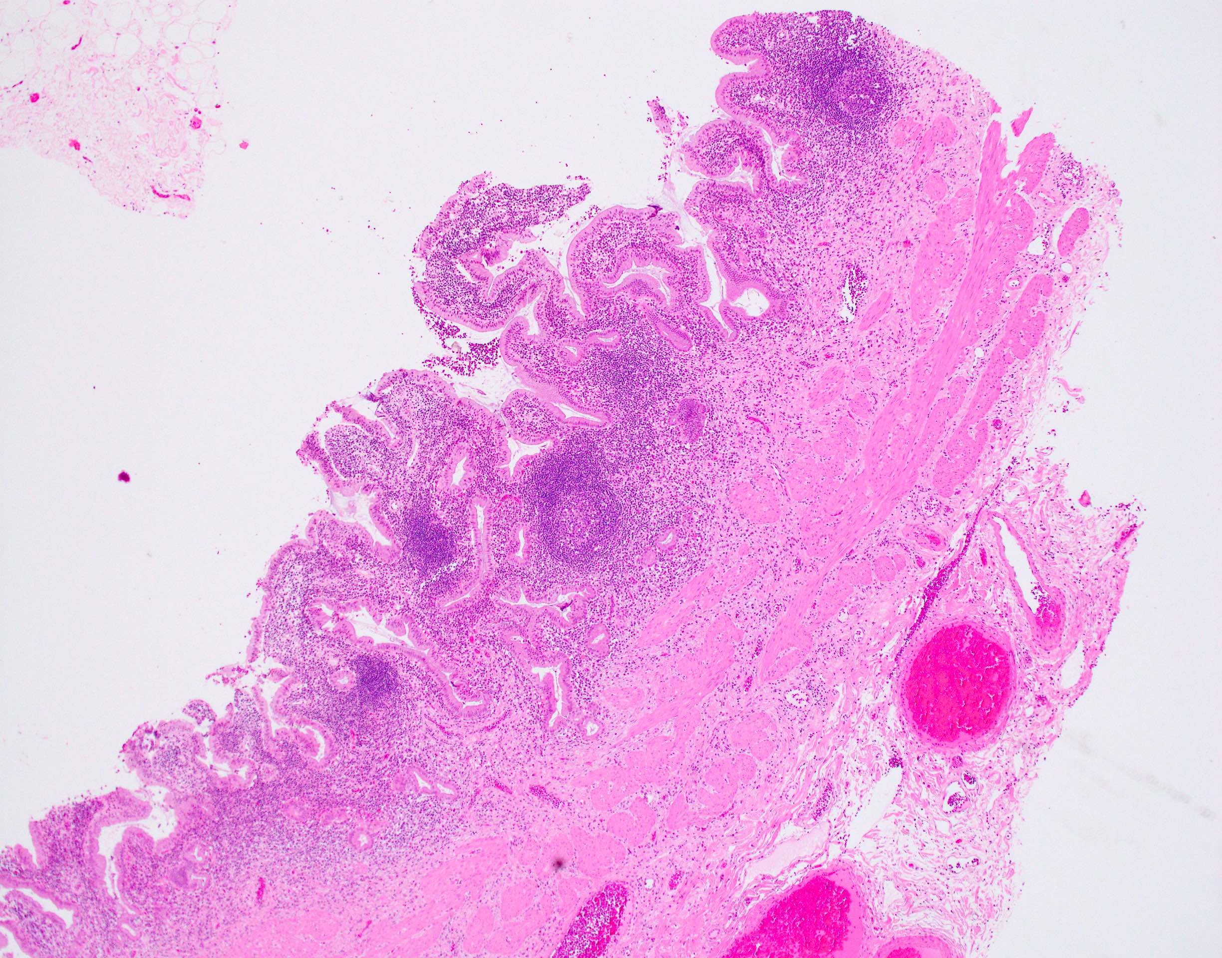 Lymphoid Aggregates: Separating Fact From Fear About Cancer - 09lkguw