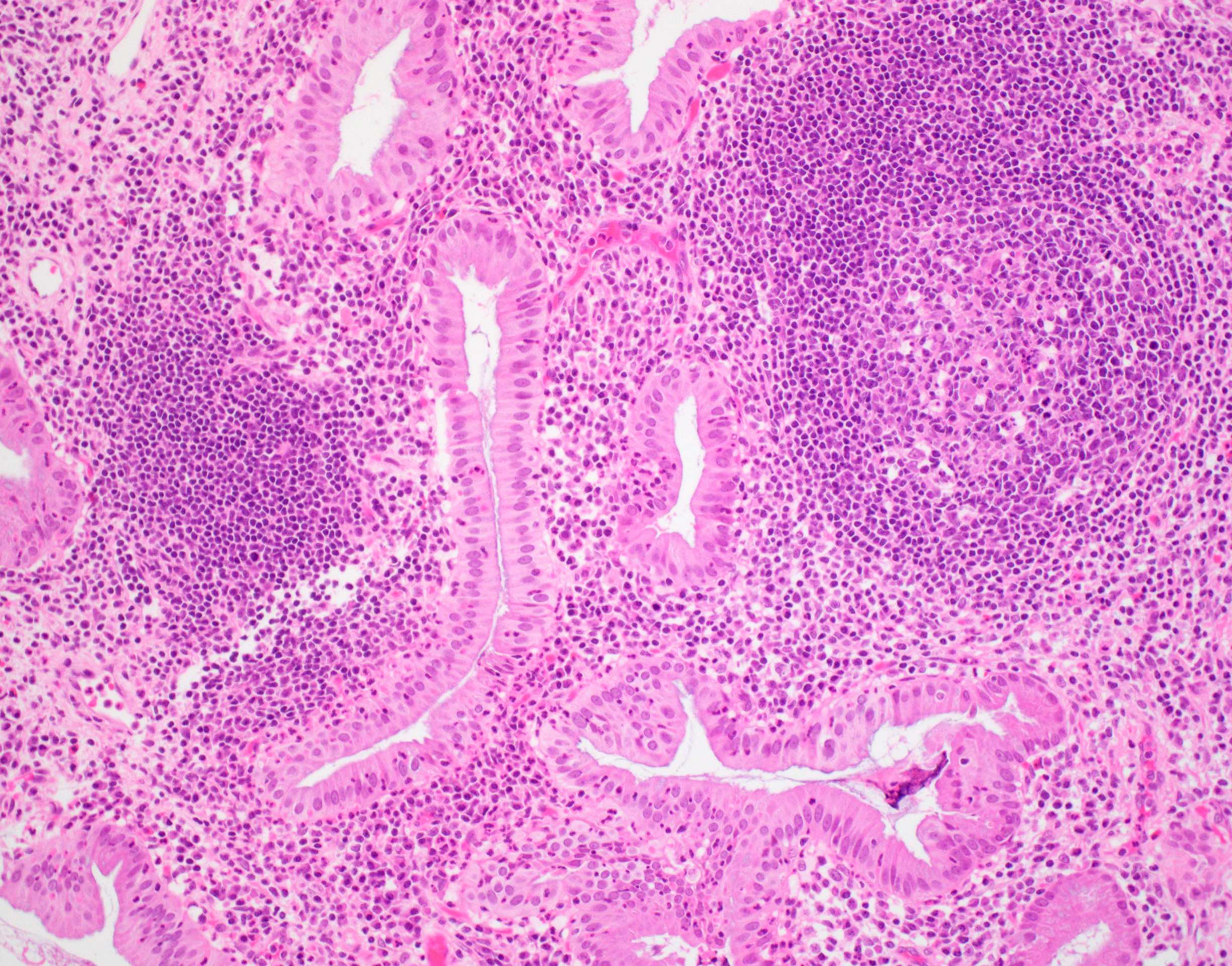 Lymphoid Aggregates: Separating Fact From Fear About Cancer - rbqk0bs