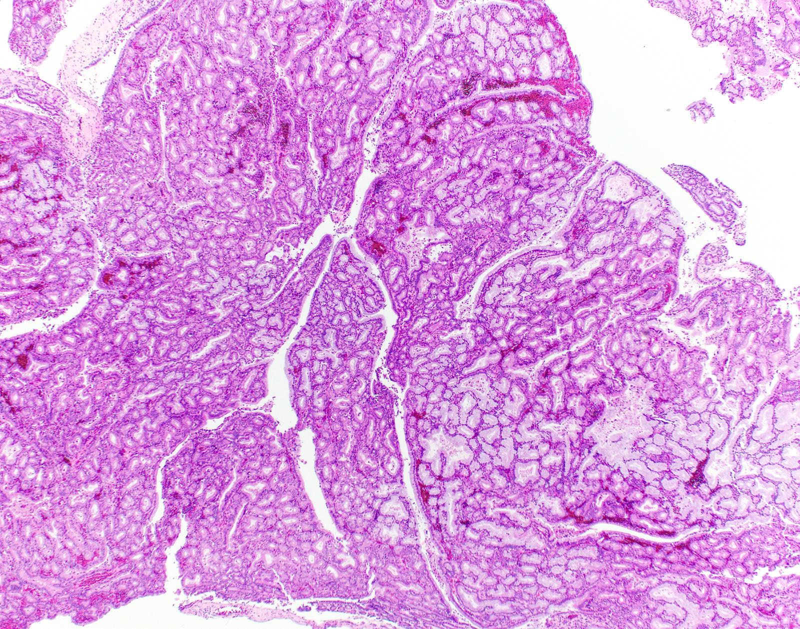 villous papilloma gallbladder