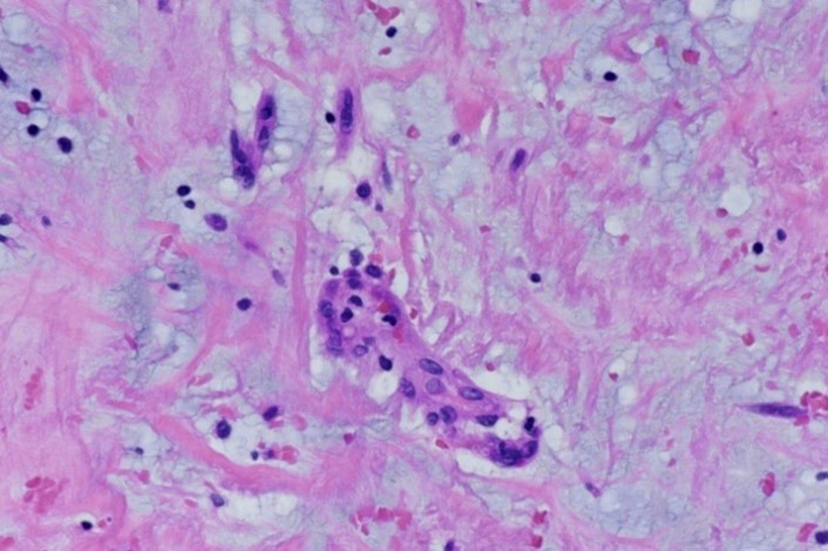 Myxoma cells in cord structure or isolated