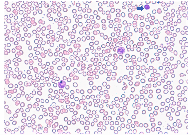 iron deficiency anemia slide